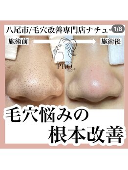 ナチュール(Natule)/毛穴改善コース