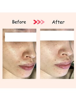 縁 整体院 和歌山院(en)/ハイドラ/毛穴洗浄