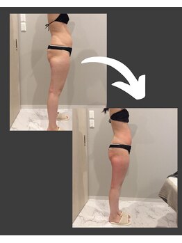 トラレス(Trouless)/脂肪冷却