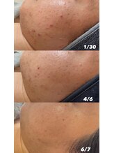 エルエーズ(Elleaise)/肌トラブルの駆け込み寺