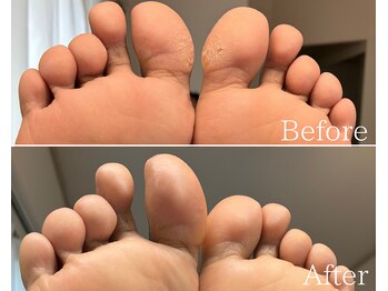 カシェット 広島店(Cachette)/30代女性☆足裏角質ケア90分