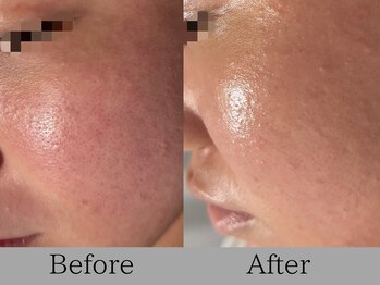 ルミライズ(lumirise)/〈4回目での効果〉