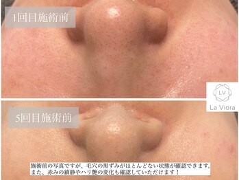ラヴィオーラ 栄(LV)/ダイヤモンドハーブピーリング