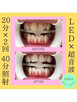 ココティ ホワイトニング(Cocotii)/ビフォーアフター