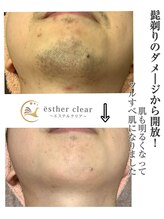 エステルクリア(esther clear)/自信をもてる爽やかフェイスに