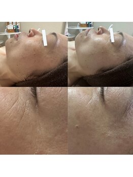 ビーンズ(BEANS)/LALAピール1回