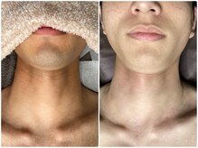 トータルビューティケア アヤ(Aya)/ヒゲ脱毛