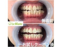 ルブラン 奈良店(Le Blanc)/白い歯っていいですよ(^_^)