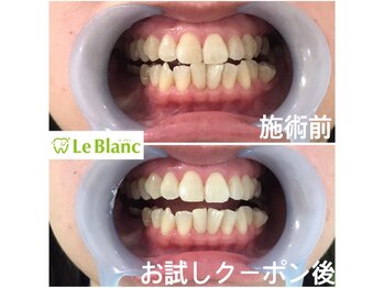 ルブラン 奈良店(Le Blanc)/白い歯っていいですよ(^_^)