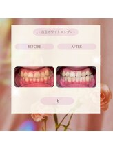 プラスビーセルフ(+b self)/ホワイトニングビフォーアフター