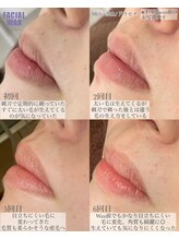 ドラセナ トータルビューティー(Dracaena Total Beauty)/毛の生え方が変わってきた!!