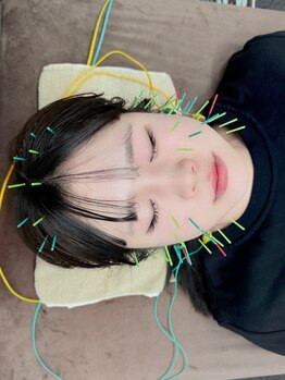 いおり鍼灸接骨院の写真/【女性鍼灸師の小顔術】深層アプローチでググっとリフトアップ！頭皮鍼×美容鍼で土台から整う理想の小顔へ