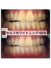 エスデザイン(es design)/セルフホワイトニング／鹿児島