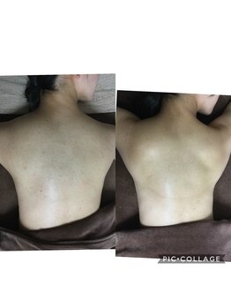 ビークレアーズ ビビ(B-crears. ViVi)/背中ハーブピーリング