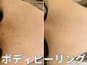【ボディーの肌トラブル改善】ハーブピーリング  ¥15800