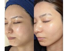 シンシア(sincere)/肌からたるみケア