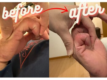 マーレ(MARE)/度重なる突き指で曲がらない