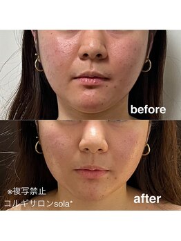 ソラ(sola*)/痩せた?と言われる圧倒的小顔