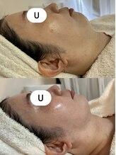 ウララカ(uraraca)/レモンボトル4回ビフォアプ