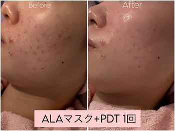 カレンジェビューティー(CarengeBeauty)/OMEGA PDT