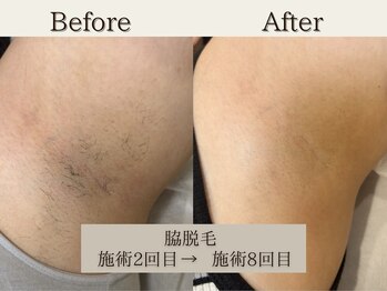 インベスト(INVEST)/脇脱毛