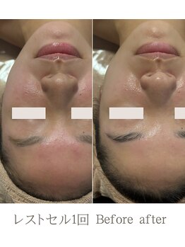 エソール(essor)の写真/毛穴洗浄×小顔ケアで透明感アップ！大人女性の肌悩みに応える結果重視の肌質改善フェイシャル専門サロン