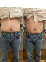 長寿鍼灸院 長寿整骨院/EMS＜お腹集中コース＞