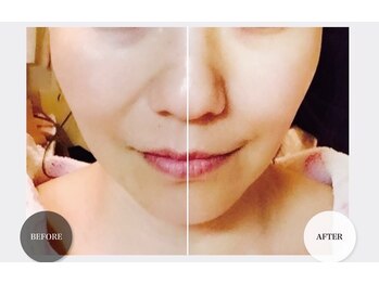 GRACETHOUSAND(グレイスサウザンド)/ハーブピーリング/シワケア