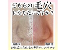 毛穴改善！黒ずみ毛穴・いちご鼻卒業！