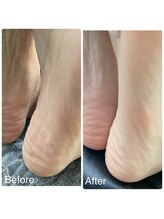 ネイルアトリエ ボン(nail atelier bon)/足裏角質ケア