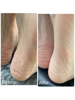 ネイルアトリエ ボン(nail atelier bon)/足裏角質ケア