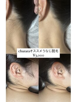 チュララ(Churara)/うなじ脱毛　¥3,000
