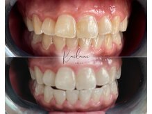 カイラニ サロン(Kai lanl salon)/ホワイトニング