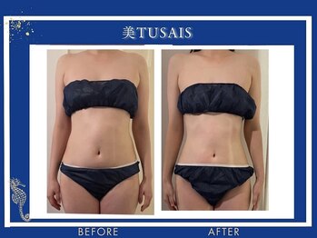 ビテュセ(美Tu sais)/【ダイエット・痩身】ボディケア