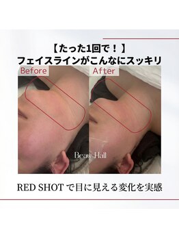 トータルクリア(TOTAL CLEAR)/RED SHOT　フェイスライン