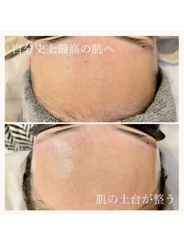 アトリア(ATRIA)/艶肌フェイシャルWax