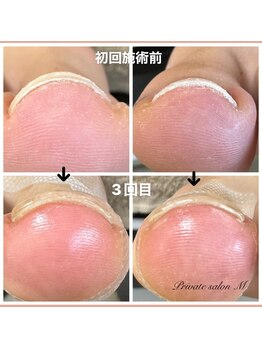 プライベートサロンエム(M)/ヘイスイッチ　巻き爪ケア
