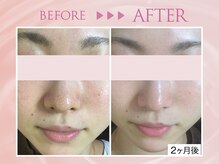 クリアラボ 錦糸町(Clear Lab)/韓国肌管理&毛穴洗浄専門店