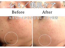ルーミー(LUME.)の雰囲気（【シミケアし放題】大きいしみ～小さいしみにアプローチ）