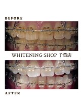 ホワイトニングショップ 千葉店/矯正中でもホワイトニング◎