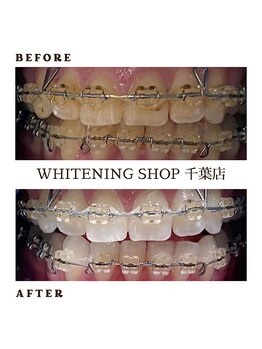 ホワイトニングショップ 千葉店/矯正中でもホワイトニング◎
