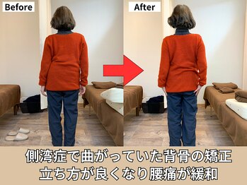 東林間整骨院/側湾症による腰痛が緩和