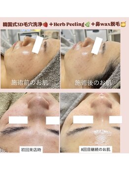 クレヴィー(Creviy)/3D毛穴洗浄+ハーブ+鼻wax