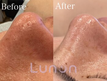 ルノン(Lunon)/毛穴洗浄ハイドロ