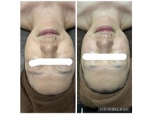 テラスアップ(Terrace UP)/【脂肪分解マシン】フェイシャル