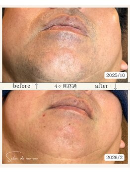 サロンド モーモ(SALON de mo-mo)/4ヶ月でこの結果:髭