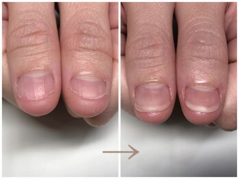 アウェイク ネイル(Awake Nail)の写真/繰り返す深爪に長年悩んできた方へ。当店は“見た目を整えるだけ”ではなく爪を育てながら回復へ導きます。