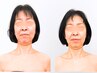 【小顔 + 小顔矯正】クリニックでも出来ない、顔の縦長を解消したい