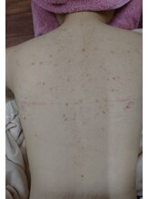 サロンエム(Salon m)/背中ニキビケア