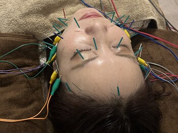 マル(malu)の写真/【大人気の美容鍼を体験◎】術後すぐに効果を体感できる、速効性の高い電気あり！美容鍼¥4300～